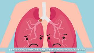 Vídeo 1  ¿Qué es la Fibrosis Quística [upl. by Acinej963]