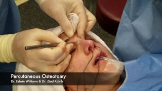 Percutaneous Osteotomy amp Breaking the Nose During Rhinoplasty Surgery [upl. by Truelove]