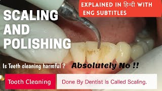 How Scaling is done   Teeth cleaning  Scaling and Polishing [upl. by Nosmirc]