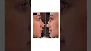 NonSurgical Nose and Chin Contouring [upl. by Anilyx]