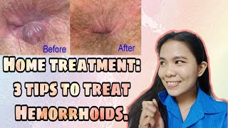 3 TIPS TO CURE HEMORRHOIDS OR quotALMORANASquot  HOME TREATMENT2020  Philippines  Angeleca Gelacio [upl. by Weinrich]