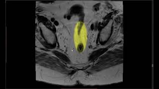 Diagnosis of Stage III Colon Cancer [upl. by Trisha]