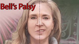 The Difference Between Bells Palsy and Stroke Symptoms [upl. by Sapers]