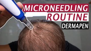 My Microneedling Routine and Derma Rolling for Hair Loss [upl. by Enaelem]