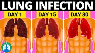 Top 10 Natural Lung Infection Treatments Home Remedies [upl. by Ennaillij510]