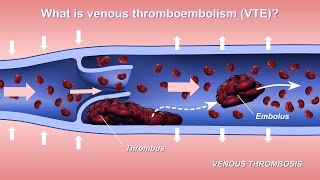 TACE and TAE transarterial chemoembolizationtransarterial embolization  Ohio State Medical Center [upl. by Marrin]