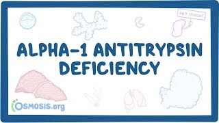 Alpha1 Antitrypsin Deficiency  causes symptoms diagnosis treatment pathology [upl. by Stephen798]