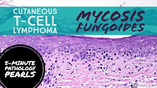 Folliculotropic Mycosis Fungoides Cutaneous Tcell Lymphoma amp Follicular Mucinosis [upl. by Ariamat582]