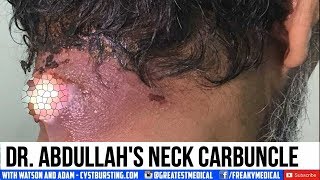 Dr Abdullahs Neck Carbuncle Furuncles and Boils [upl. by Hope]