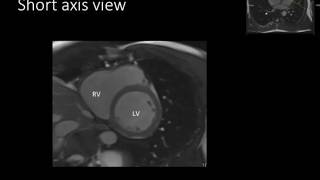 Fourth ventricle  neuroanatomy  floor  opening [upl. by Tereve]