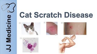 Cat Scratch Disease  Causes Symptoms and Treatment [upl. by Akram697]