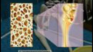 Osteoporosis3D Medical Animation [upl. by Amoreta]