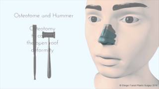 Breaking the Nose  Rhinoplasty Animation  Osteotomy [upl. by Sorkin]