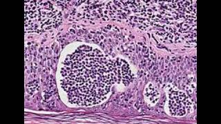 Histopathology SkinMycosis fungoides [upl. by Anisah]