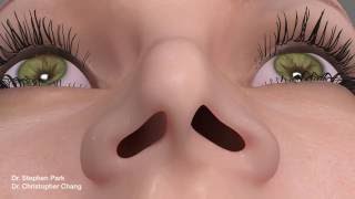 Pinched Narrow Nose Rhinoplasty to Address Nasal Obstruction [upl. by Saffren]