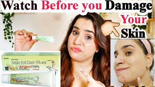 AZIDERM Cream for Clear Skin My HONEST Experience and RESULTS [upl. by Enelkcaj]