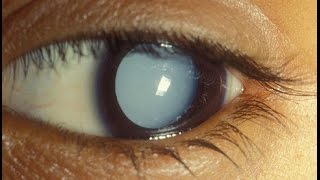 Cataract Aphakia and Pseudophakia Examination [upl. by Olivie]