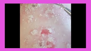 Plaque Psoriasis Removal  How to remove psoriasis [upl. by Assenov]