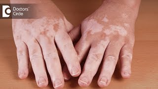 What are the precautions to take against vitiligo  Dr Aruna Prasad [upl. by Evreh]