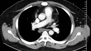 Mediastinal anatomy and nodal stations on CT [upl. by Samale]