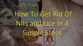 How To Get Rid Of Nits and Lice In 4 Simple Steps [upl. by Mauretta75]