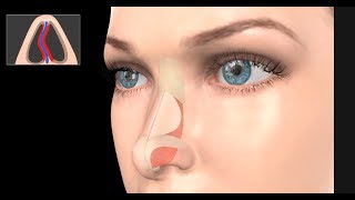 Deviated Septum Surgery Septoplasty [upl. by Sipple]