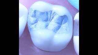 Class II Amalgam Restoration 1  Operative Dentistry [upl. by Phedra908]