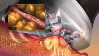 How VelaShape Works [upl. by Weismann]