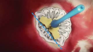 Transcatheter Mitral Valve Replacement Neovasc [upl. by Annairdna911]