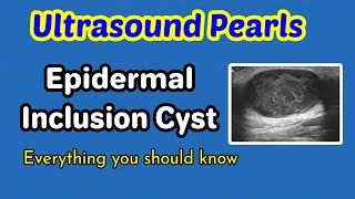 Are Cysts on the Kidneys Serious [upl. by Desai430]