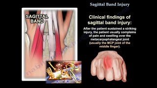 Sagittal Band Injury  Everything You Need To Know  Dr Nabil Ebraheim [upl. by Cornwell]