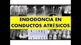 quotENDODONCIA EN CONDUCTOS ATRÉSICOSquot [upl. by Jenda]