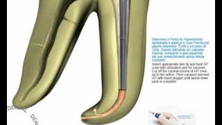 Sistema de obturación con gutapercha termoplastificada [upl. by Manya]