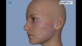 Understanding Facial Palsy [upl. by Hummel]