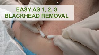 Easy as 1 2 3 Blackhead Removal  Dr Derm [upl. by Jenette246]