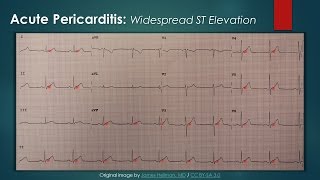 Acute Pericarditis ECG [upl. by Seugirdor]