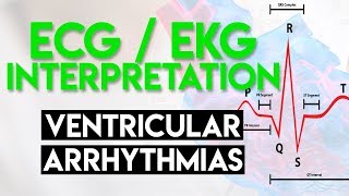 Ventricular Arrhythmias  ECG EKG Interpretation Part 5 [upl. by Ynettirb557]