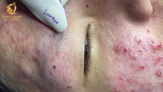 Treatment of acne tablets pustules and blackheads 360  Loan Nguyen [upl. by Rundgren]